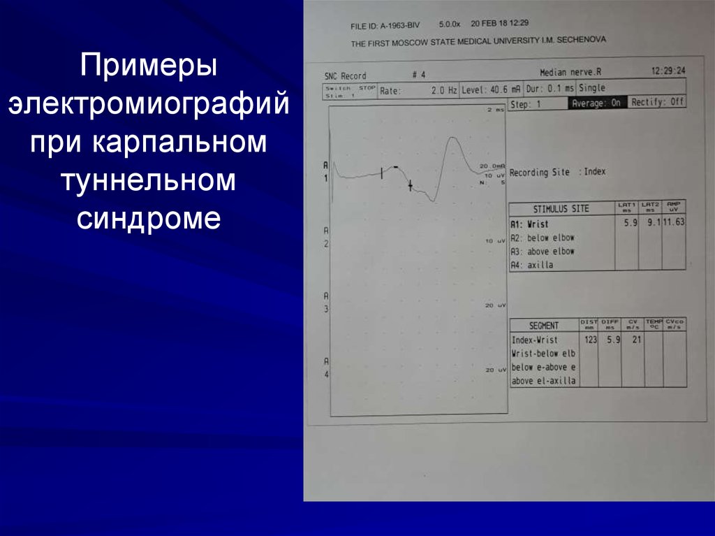 Синдром вертебробазилярной артерии карта вызова