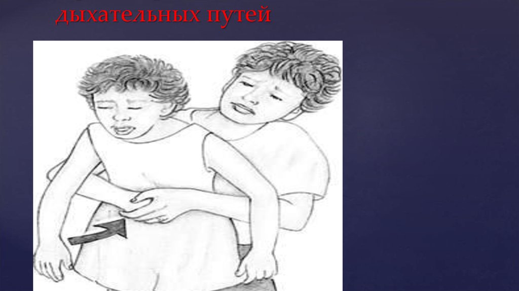 При инородном теле дыхательных путей