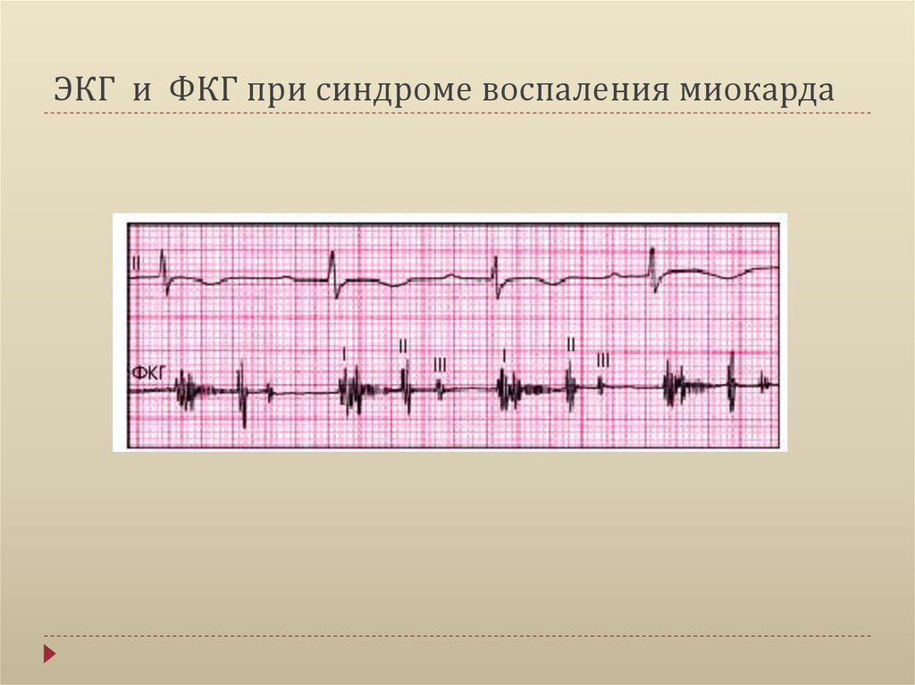 ЭКГ и ФКГ при синдроме воспаления миокарда