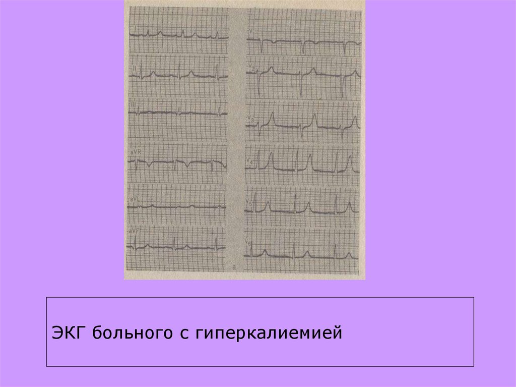 Гиперкалиемия на экг. ЭКГ С гиперкалиемией. ЭКГ пациента с гиперкалиемией. ЭКГ при гиперкалиемии картинки. Фон для презентации ЭКГ.