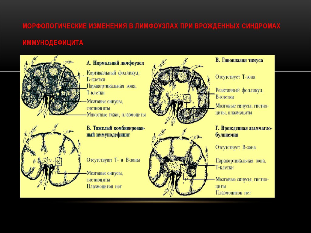 Асимметрия синусов головного мозга. Лимфоузлы при иммунодефиците. Иммунодефицит отсутствие лимфатических узлов. Лимфоузел при иммунодефиците.