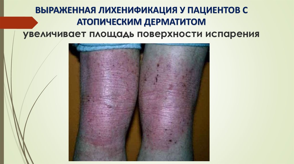 ВЫРАЖЕННАЯ ЛИХЕНИФИКАЦИЯ У ПАЦИЕНТОВ С АТОПИЧЕСКИМ ДЕРМАТИТОМ увеличивает площадь поверхности испарения