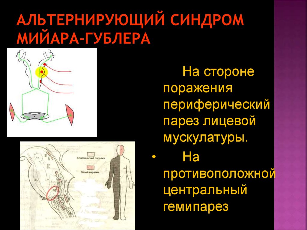 Альтернирующие синдромы схема