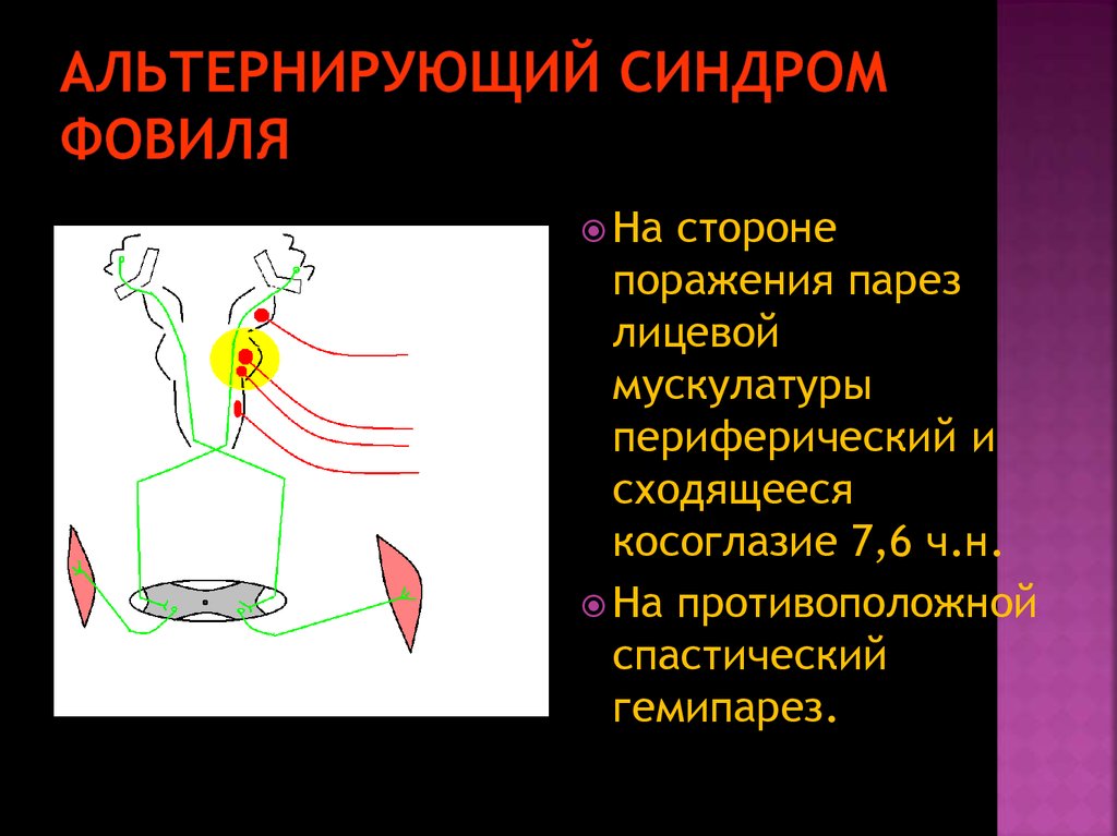 Синдром фовилля. Альтернирующий синдром Вебера. Альтернирующий синдром Бенедикта. Альтернирующий симптом Вебера. Альтернирующий паралич Вебера.