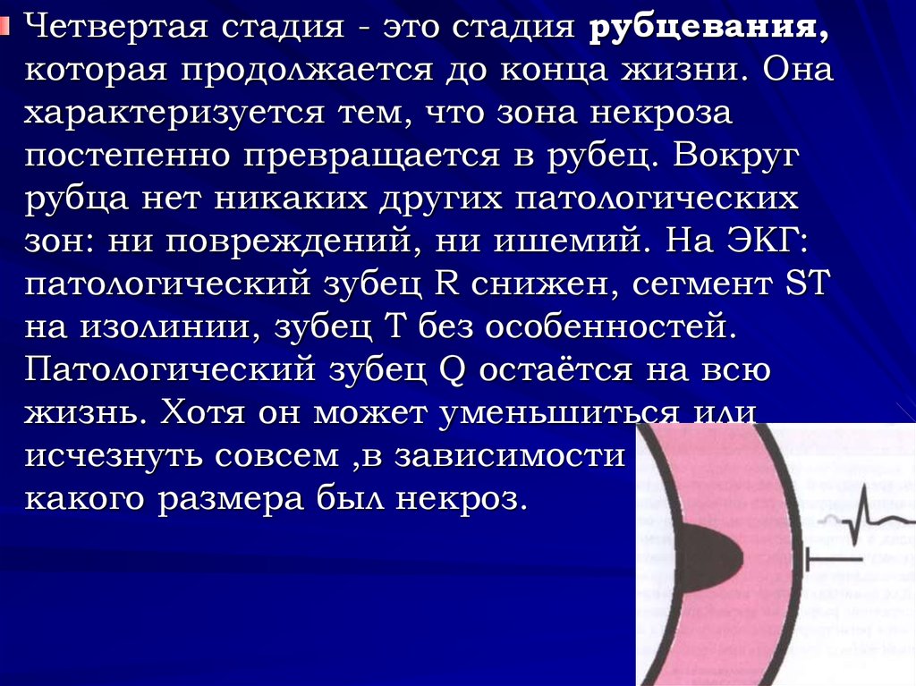 Стадия это. Стадия рубцевания инфаркта миокарда. Образование рубца в зоне инфаркта миокарда. Стадия.