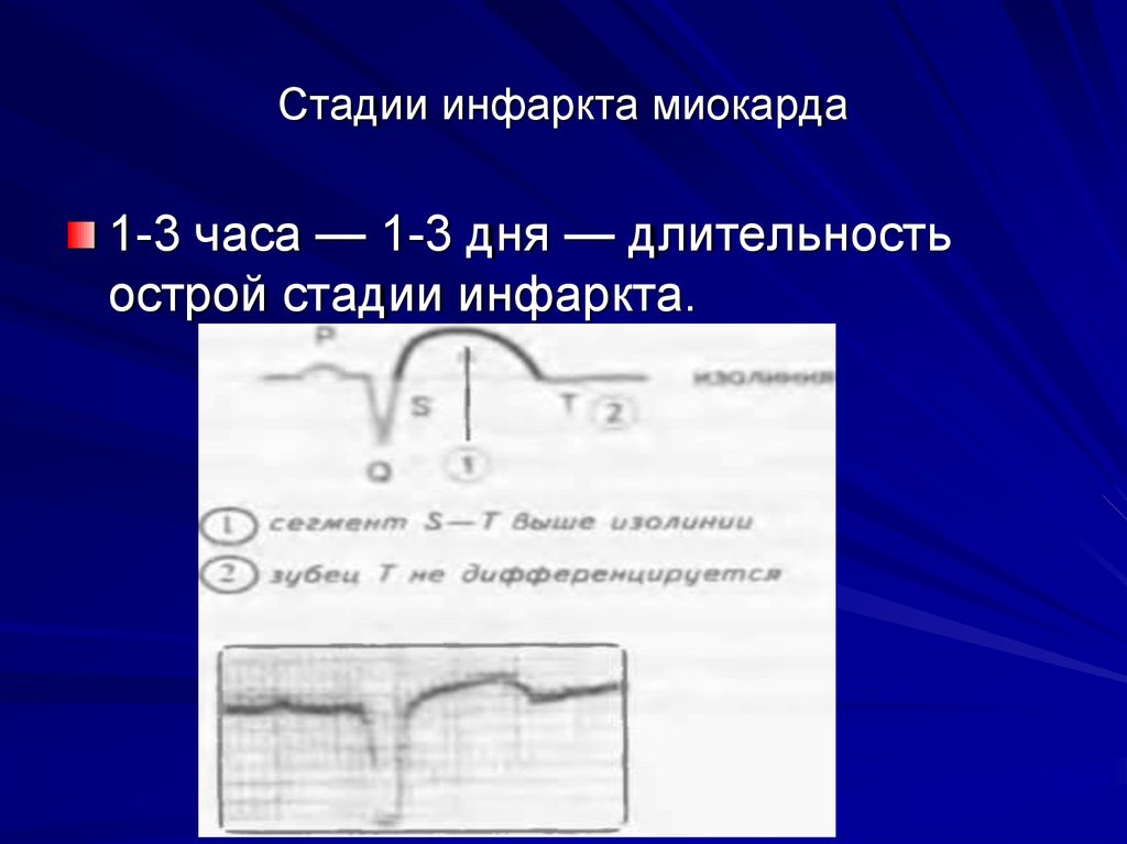 Стадии инфаркта миокарда. Длительность стадий инфаркта миокарда. Длительность острой стадии инфаркта. Этапы инфаркта миокарда по дням.