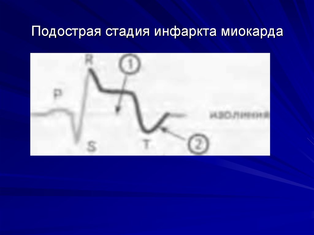 Стадии инфаркта миокарда. Подострая стадия инфаркта миокарда. Подострая фаза инфарк миркарда. Подотра ТАДИ инфаркта миокарда. Подострпя стаия инфар4та.