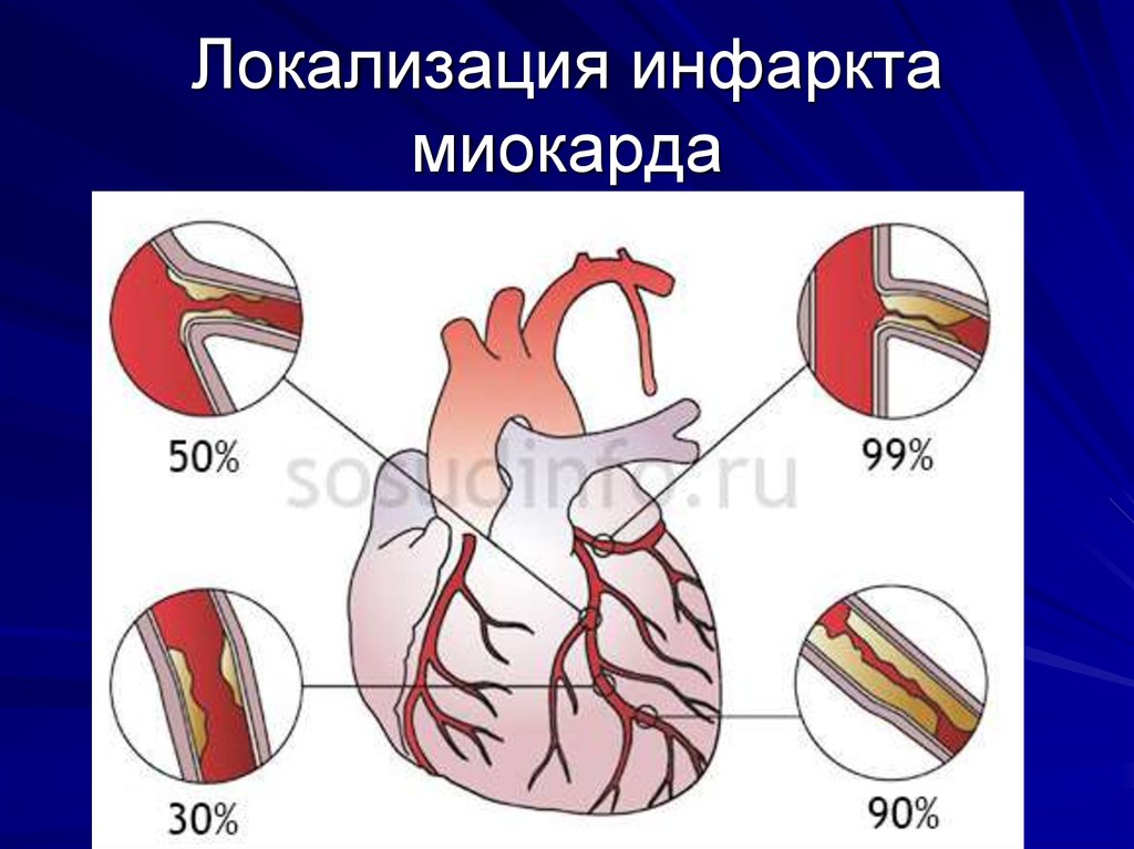 Клин картина инфаркта миокарда