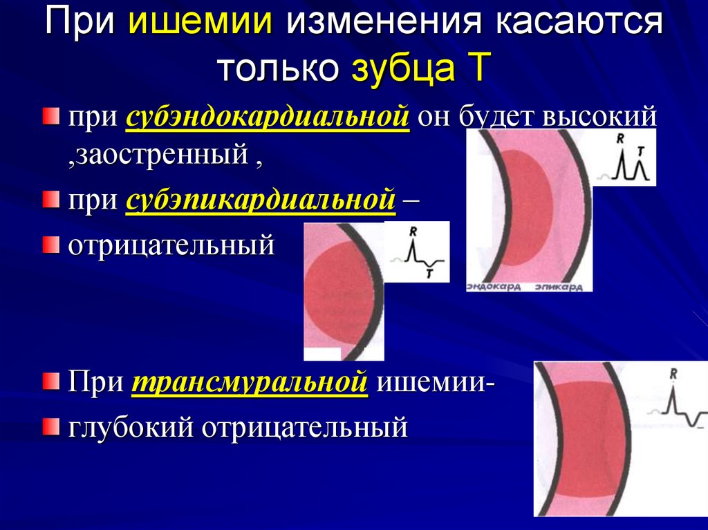 Ишемия миокарда. Субэндокардиальный инфаркт на ЭКГ. Изменения на ЭКГ, характерные для ишемии миокарда:. Субэпикардиальный инфаркт миокарда ЭКГ. Субэндокардиальная ишемия на ЭКГ.