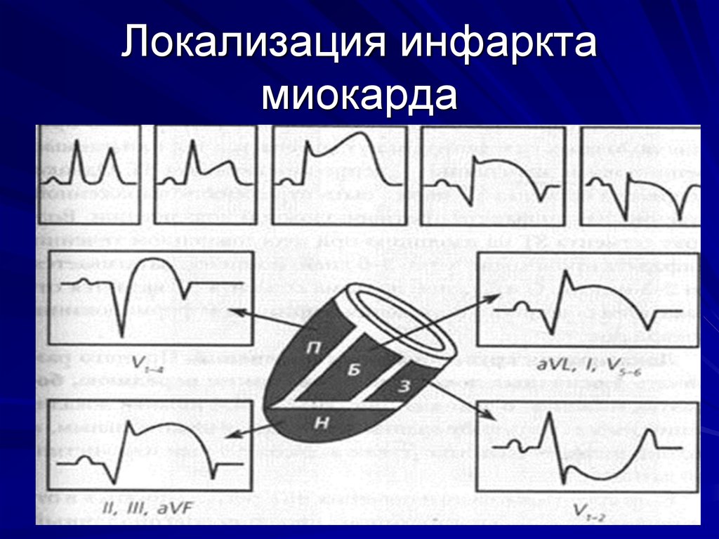 Клин картина инфаркта миокарда