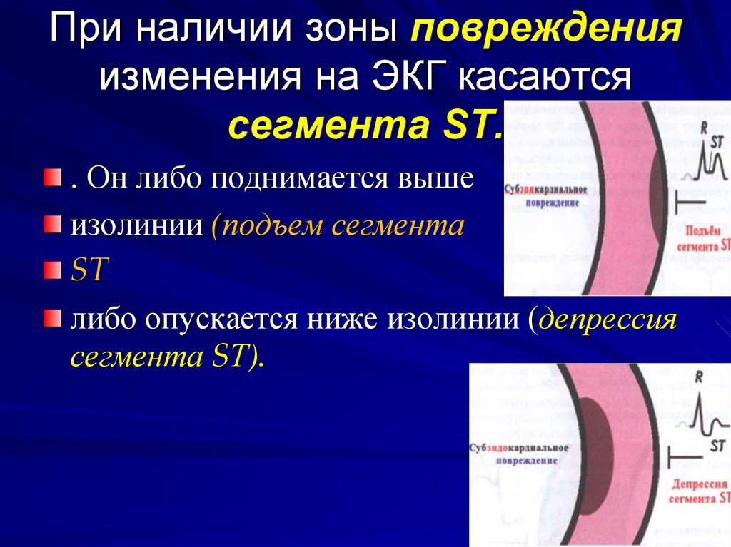 Разрыв миокарда. ЭКГ при инфаркте миокарда зона повреждения. Зону повреждения на ЭКГ отражают. Зона повреждения на ЭКГ. Зона повреждения миокарда на ЭКГ.