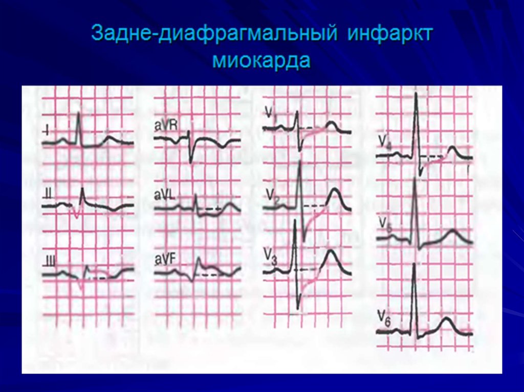 Экг при инфаркте