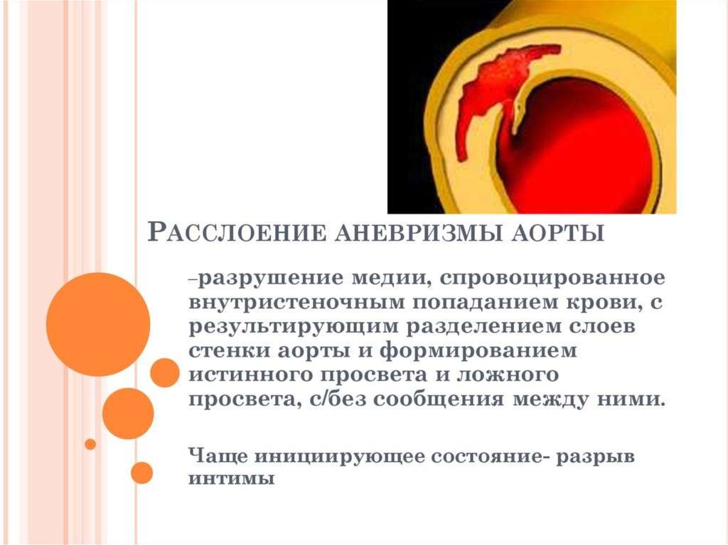 Атеросклероз брюшного. Расслаивающая аневризма аорты: атеросклероз. Симптомы расслаивающейся аневризмы аорты. Этиология расслаивающаяся аневризма аорты. Симптомы расслаивающей аневризмы аорты.