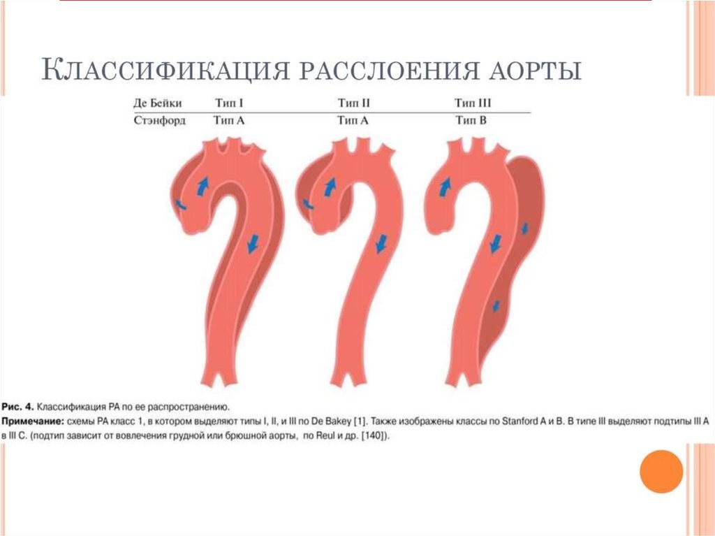 Аневризмы аорты презентация