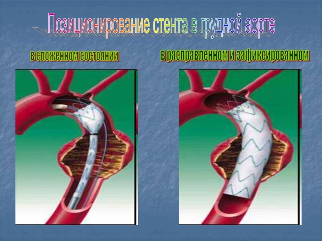 Аневризмы аорты презентация