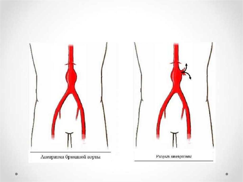 Аневризма аорты что это. Атеросклероз брюшной аорты. Аневризма брюшной аорты. Мешотчатая аневризма брюшной аорты. Мешковидная аневризма брюшной аорты.