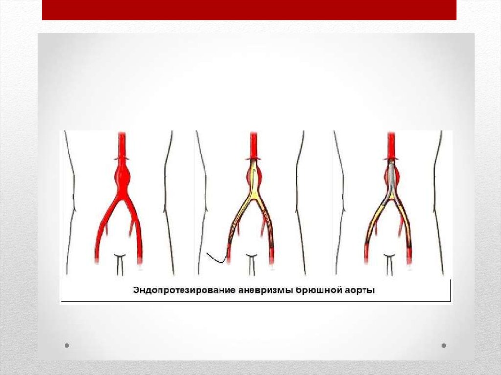 Аневризма брюшной. Эндопротезирование брюшного отдела аорты. Супраренальная аневризма. Разрыв аневризмы брюшной аорты макропрепарат. Аневризма бифуркации брюшной аорты.