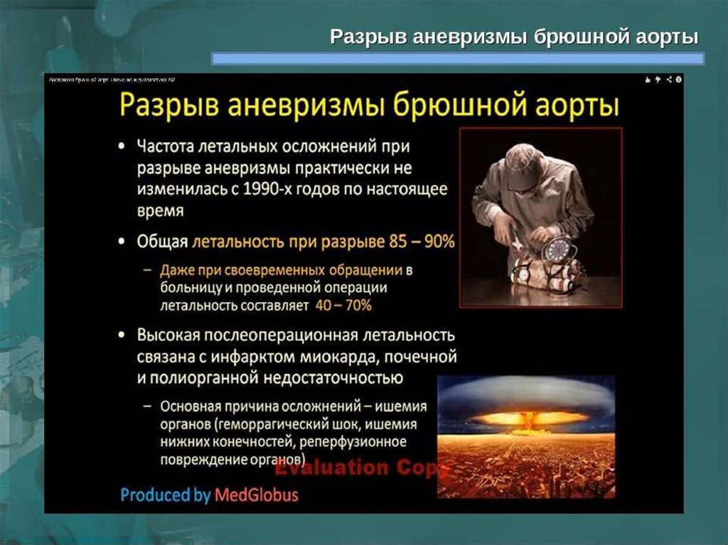 От чего бывает разрыв аорты. Разрыв аневризмы брюшной. Разрыв аневризмы брюшной аорты. Разрыв аневризма аорты. Аневризма брюшной аорты разорванная 171 3.