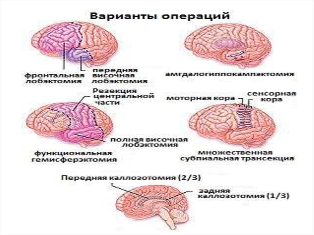 Невролог эпилепсия