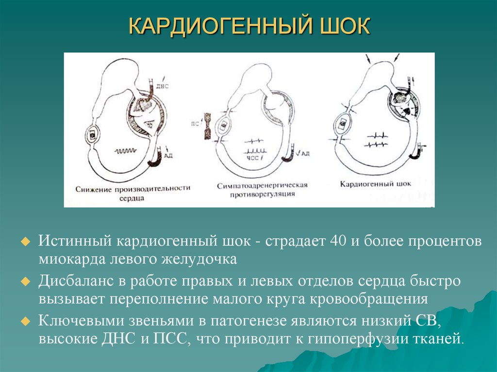 Кардиогенді шок презентация