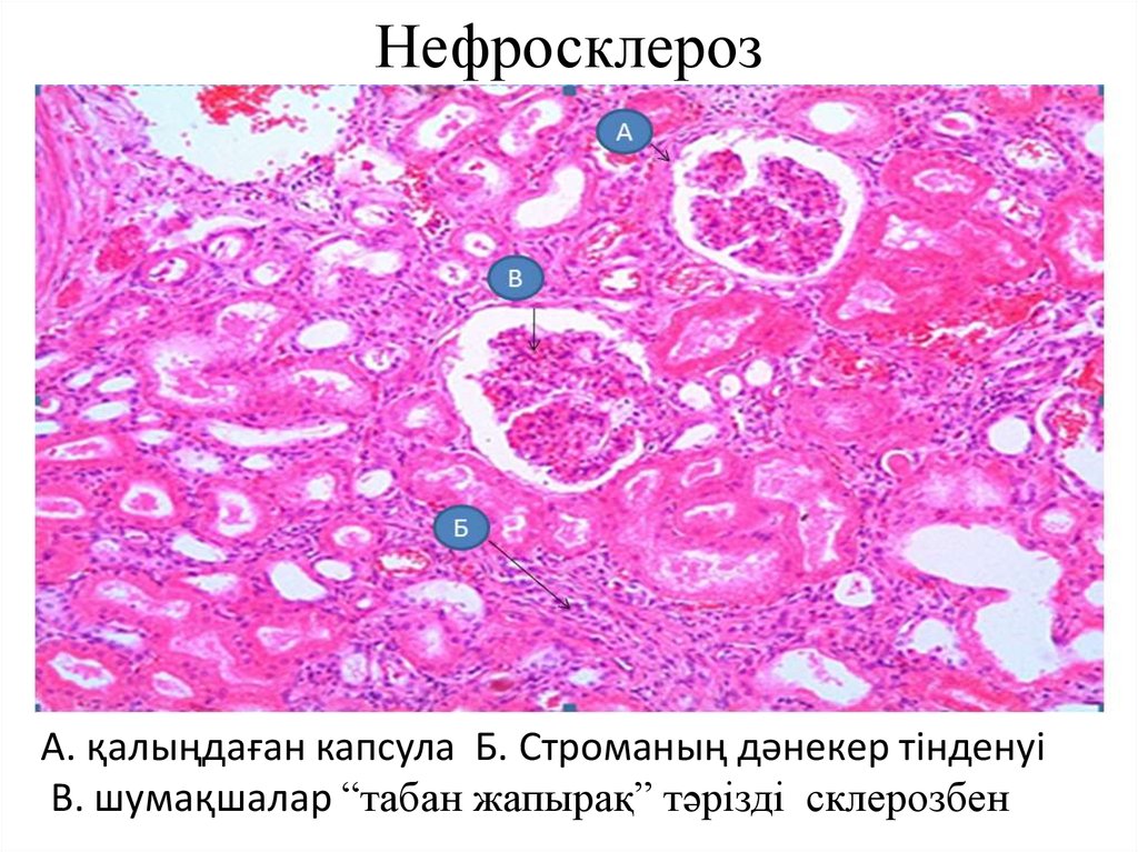 Артериолосклеротический нефросклероз микропрепарат рисунок