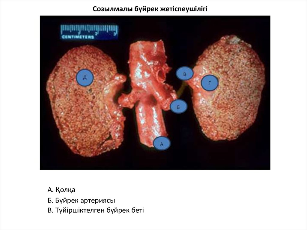 Гломерулонефрит казакша презентация
