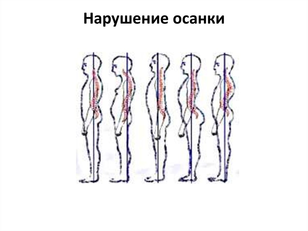 Перечислить нарушения осанки