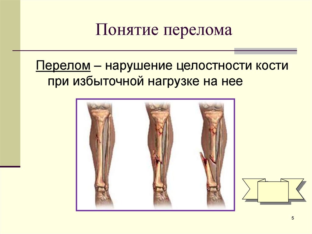 Презентация про переломы