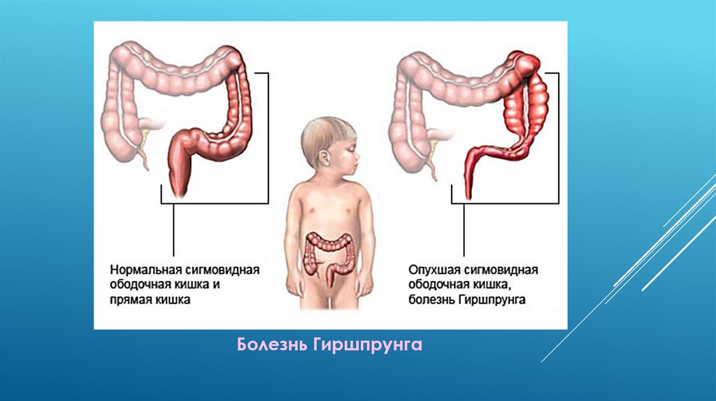 Запор после операции на кишечнике. Долихосигма у детей клинические рекомендации. Толстая кишка анатомия долихосигма. Болезнь Гиршпрунга сигмовидной кишки. Долихосигма ирригоскопия.