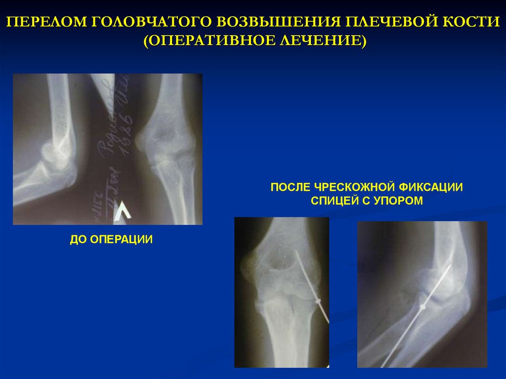 Перелом локтя со смещением. Перелом головчатого возвышения плечевой кости у детей. Перелом головчатого возвышения плечевой кости со смещением операция. Головчатое возвышение плечевой кости у детей на рентгене. Остеосинтез головчатого возвышения.