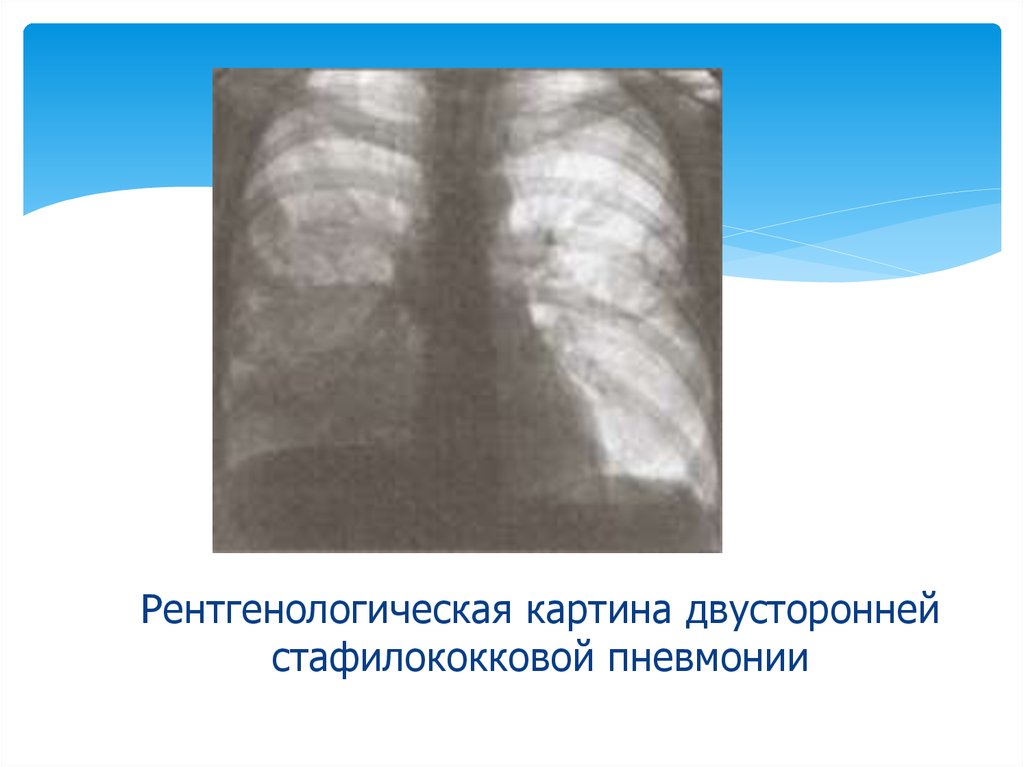 Картина пневмонии. Стафилококковая пневмония рентгенологическая картина. Рентгенологическая картина при пневмонии. Рентгенологическая картина острой пневмонии. Стафилококковая пневмония рентген.