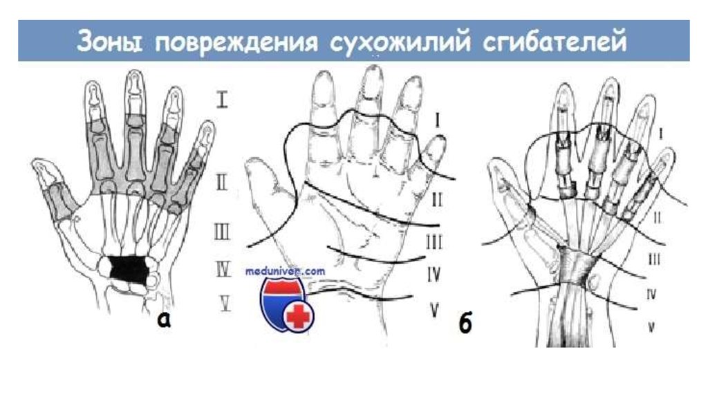 Повреждения сухожилий кисти презентация