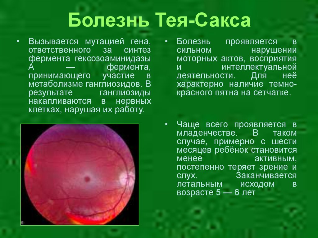 Болезнь тея сакса фото больных