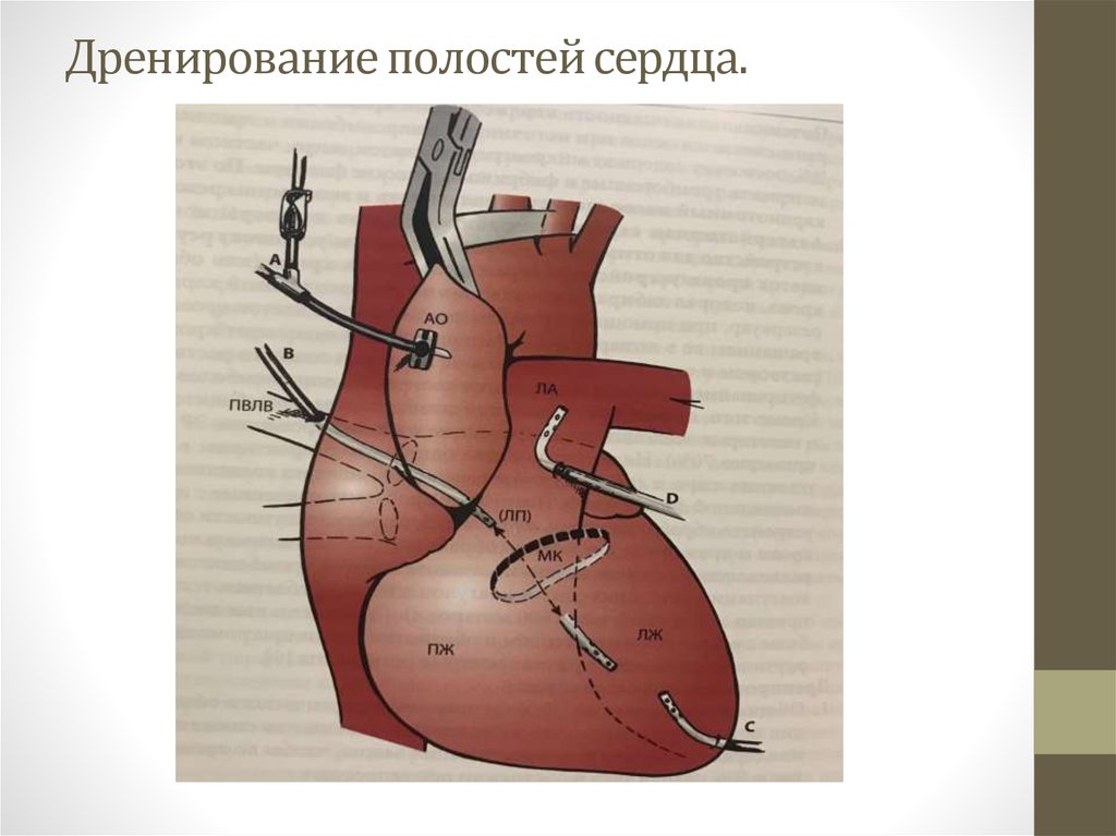 Расширенная полость сердца