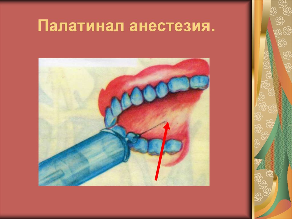 Палатинал анестезия.