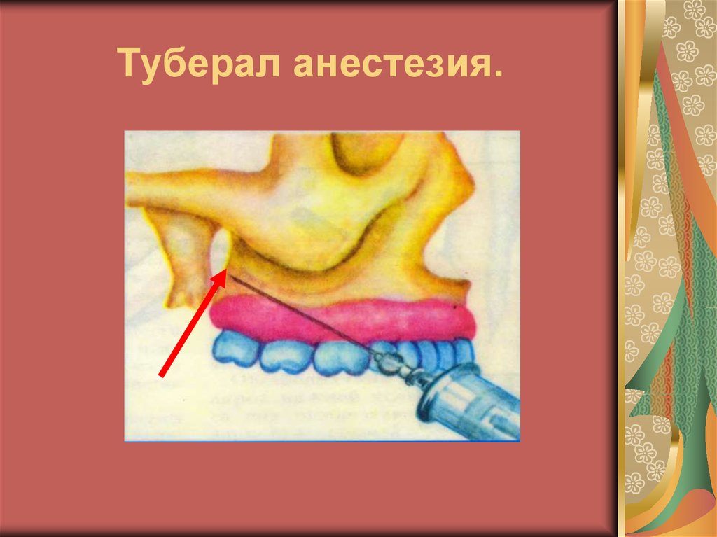 Туберал анестезия.
