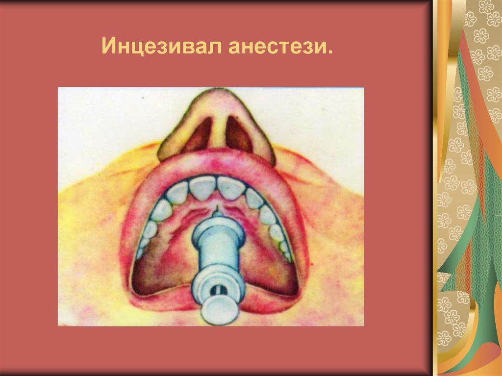 Инцезивал анестези.
