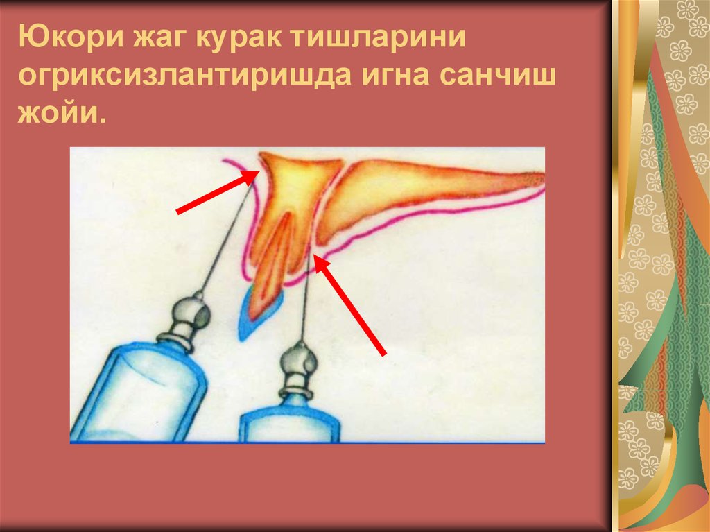 Юкори жаг курак тишларини огриксизлантиришда игна санчиш жойи.