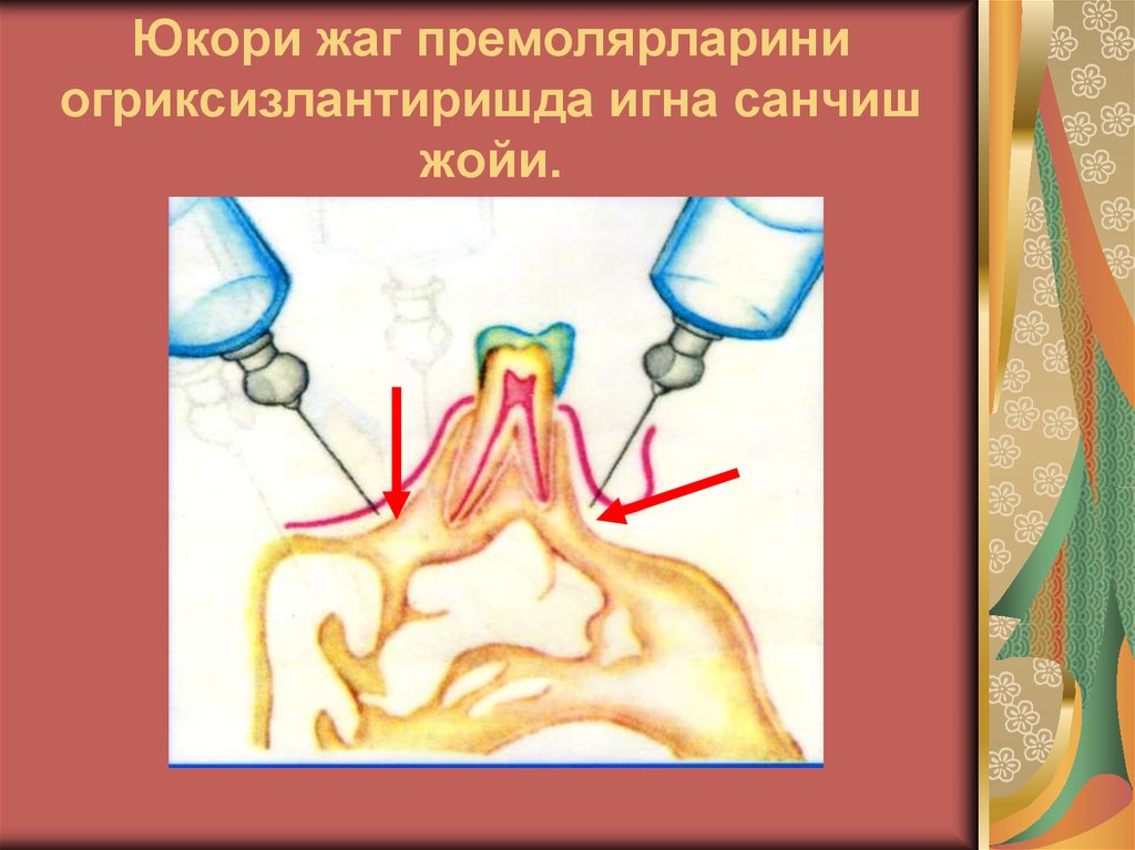 Юкори жаг премолярларини огриксизлантиришда игна санчиш жойи.