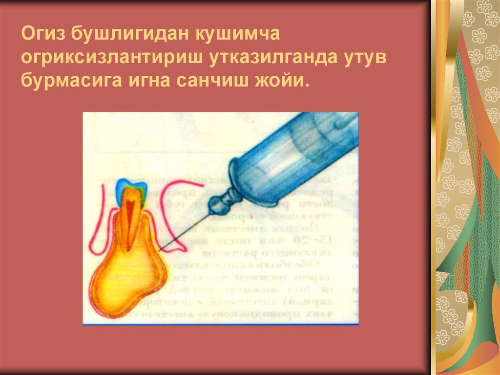 Огиз бушлигидан кушимча огриксизлантириш утказилганда утув бурмасига игна санчиш жойи.