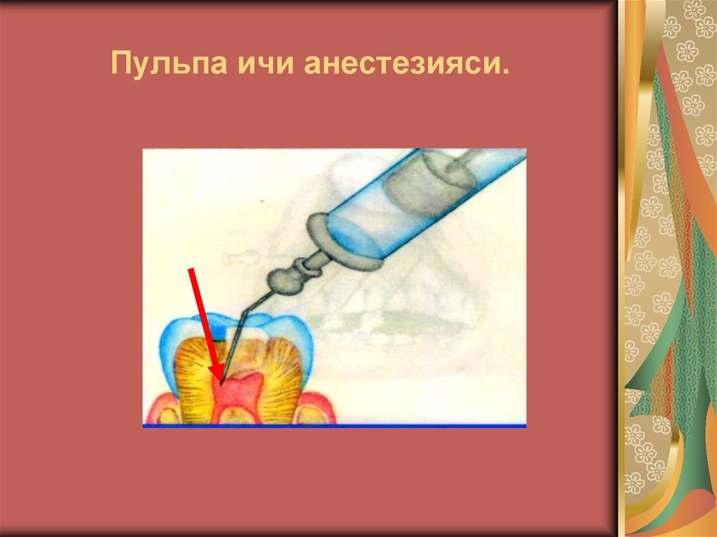 Пульпа ичи анестезияси.