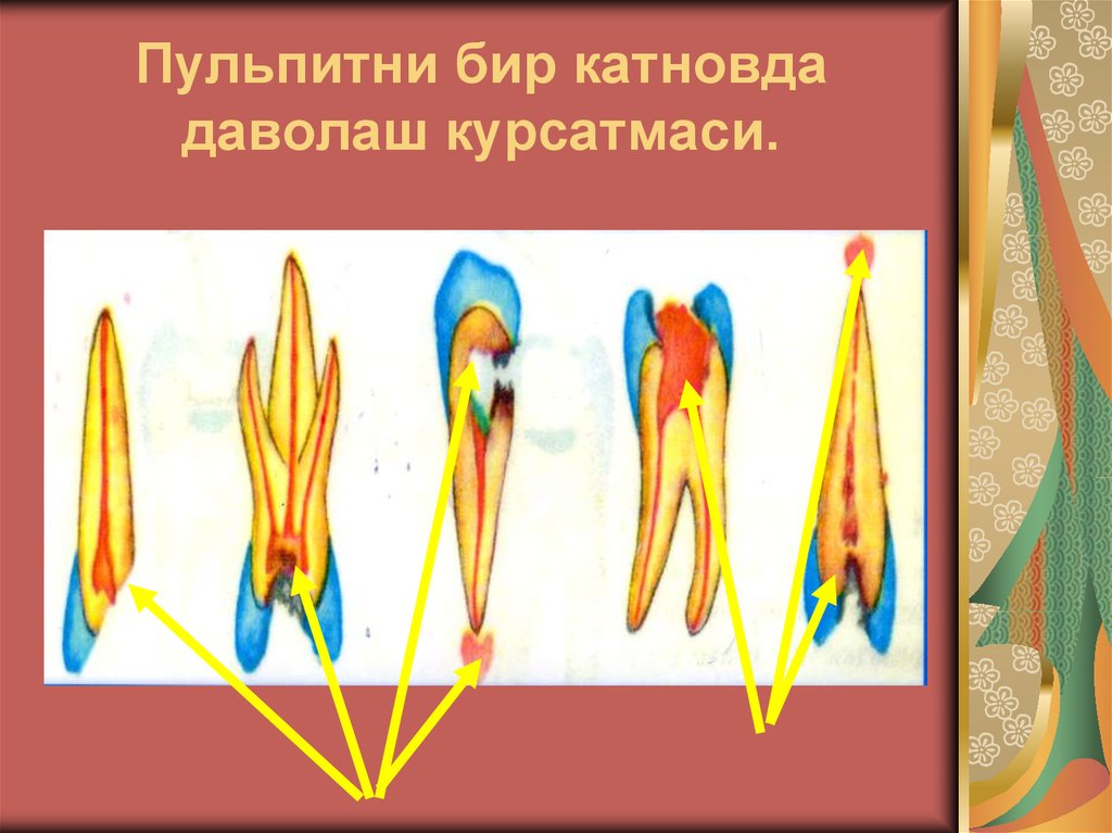 Пульпитни бир катновда даволаш курсатмаси.