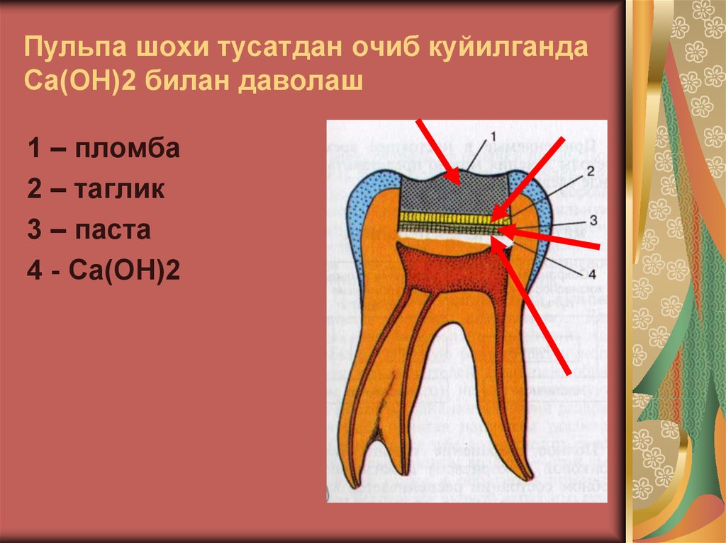 Пульпа шохи тусатдан очиб куйилганда Ca(OH)2 билан даволаш