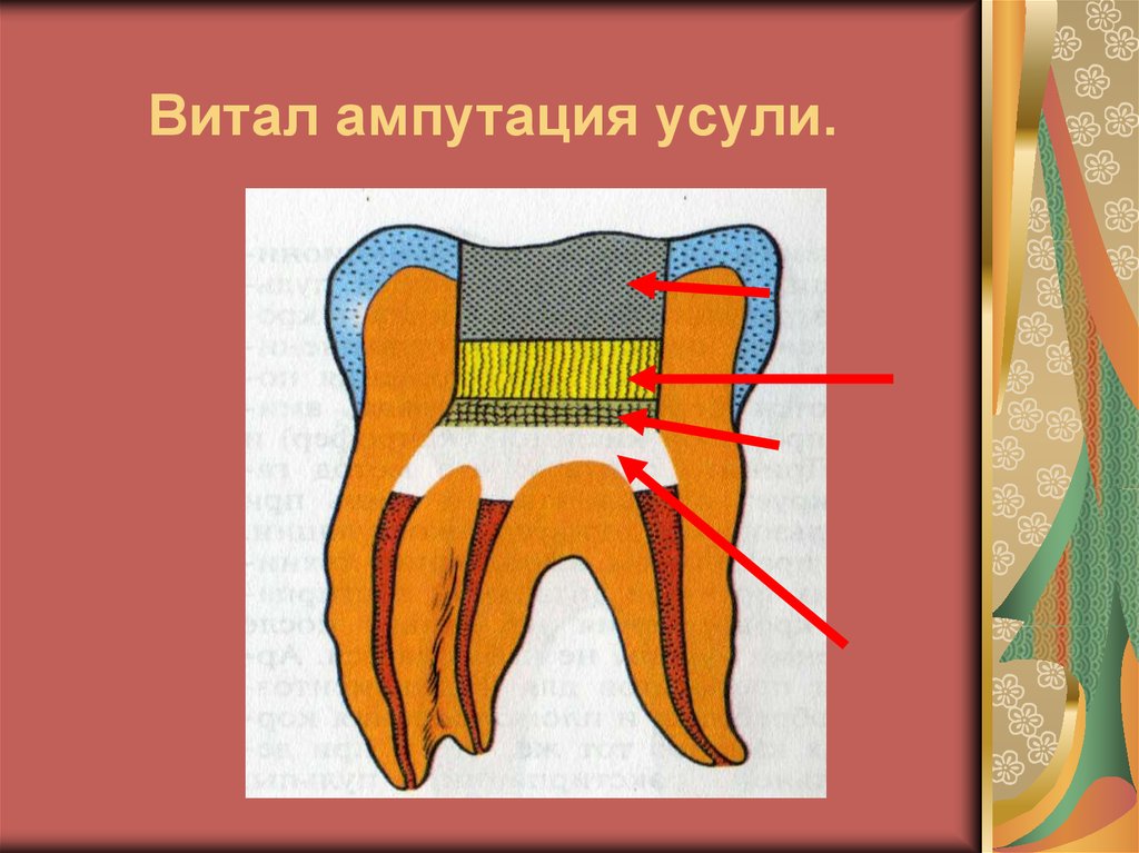 Витал ампутация усули.