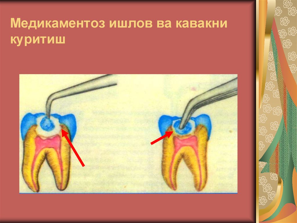 Медикаментоз ишлов ва кавакни куритиш