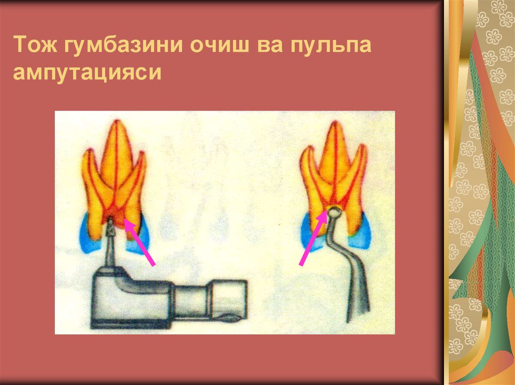 Тож гумбазини очиш ва пульпа ампутацияси