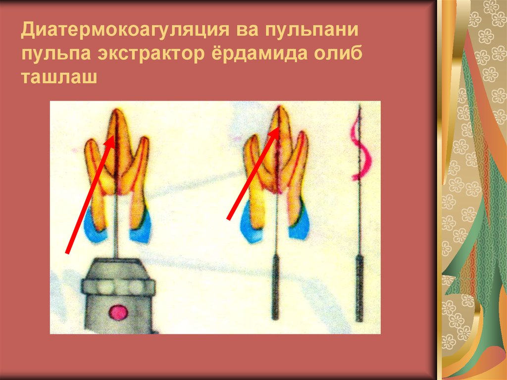 Диатермокоагуляция ва пульпани пульпа экстрактор ёрдамида олиб ташлаш