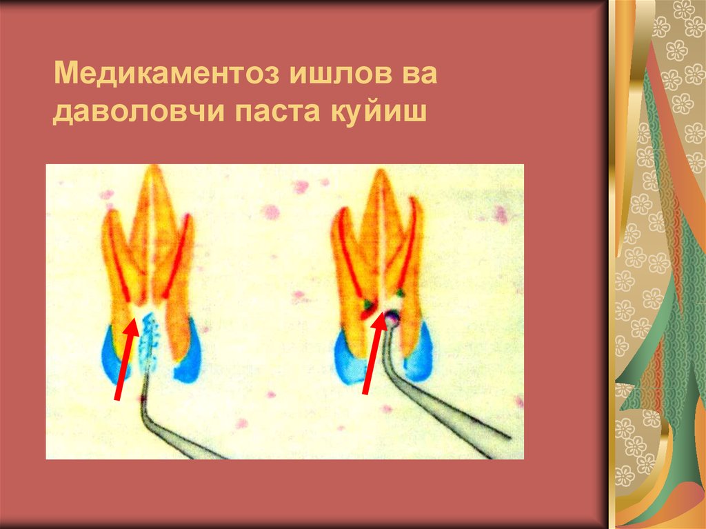 Медикаментоз ишлов ва даволовчи паста куйиш