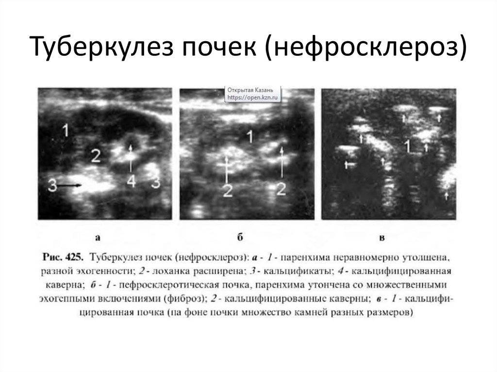 Уз признаки. Туберкулез паренхимы почек рентген. Туберкулез паренхимы почек на УЗИ. Нефросклероз УЗИ признаки.