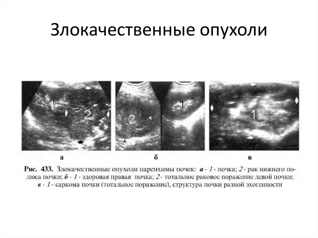 Как выглядят опухоли на узи